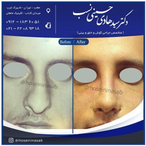 بعد از عمل بینی چی بخوریم
