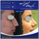انحراف بینی
